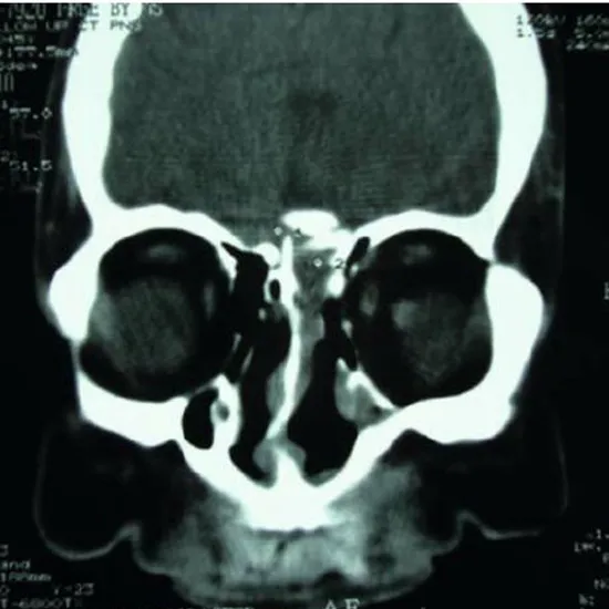 CECT PNS Sagittal